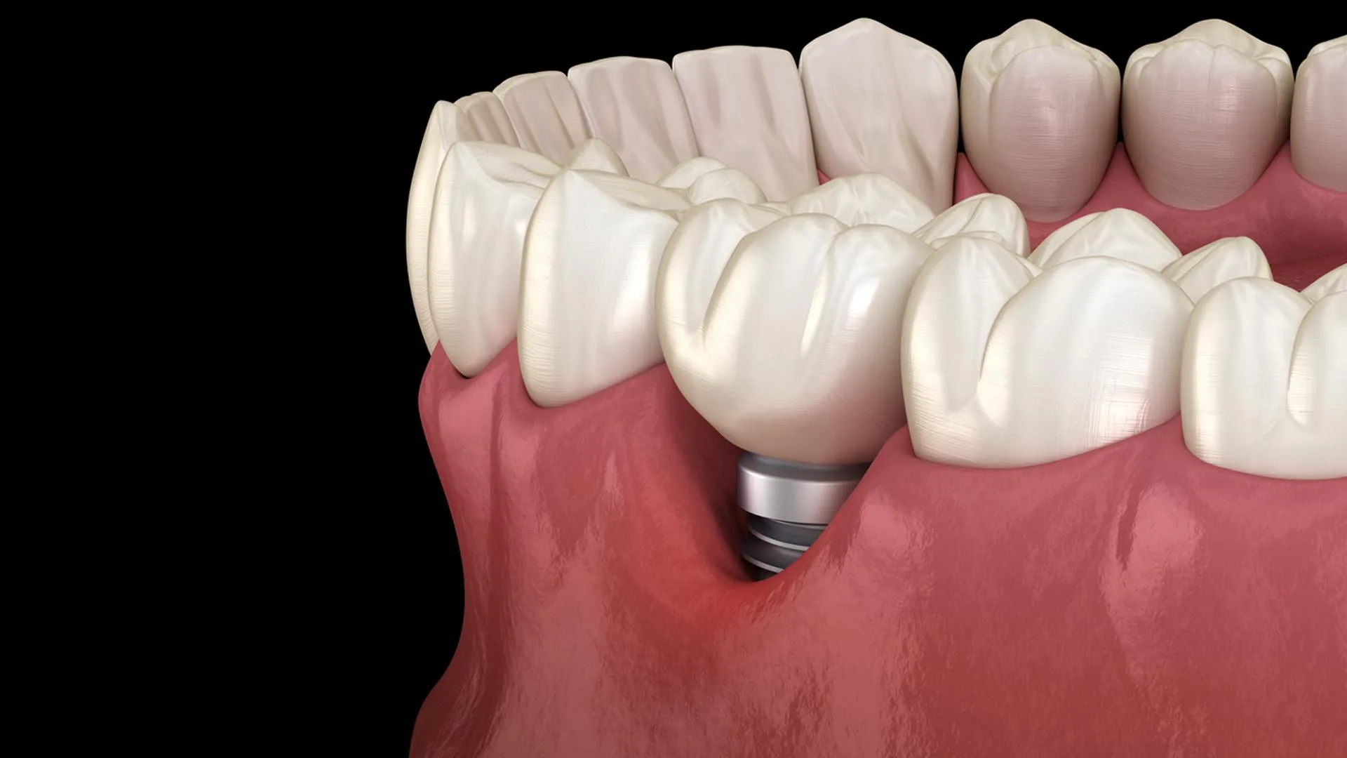 Dental Implant Infection Care